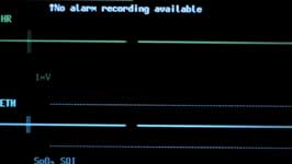 The accident victim's EKG goes flat